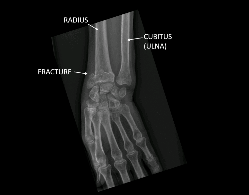Fracture du radius distal Centre Main Sud Loire