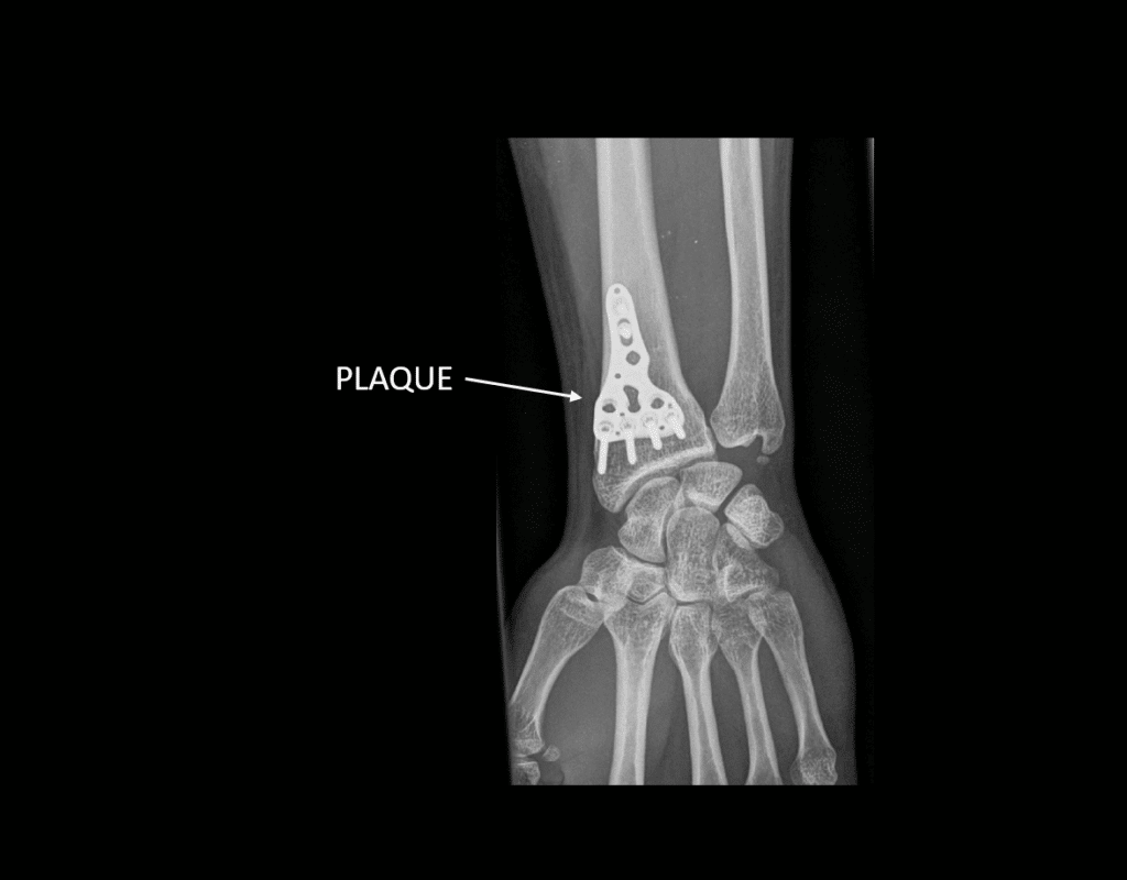 Fracture du radius plaque palmaire Centre Main Sud Loire