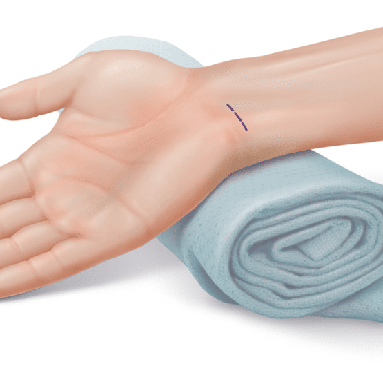 Les pathologies du poignet et leurs traitements - Dr Thong 